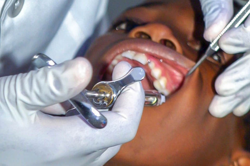 All About Tooth Extraction