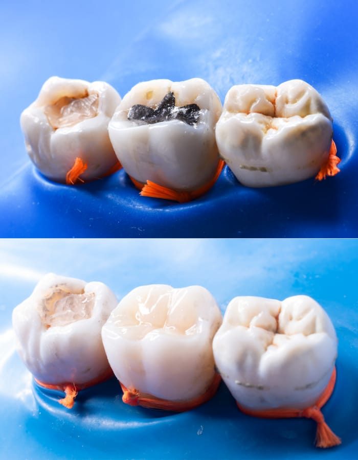 dental fillings illustrated on the image