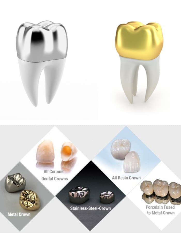 dental crown tooth shaped cap to protect damaged teeth