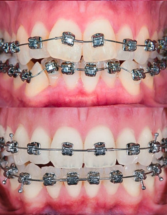 dental or metal braces used to align or straighten teeth