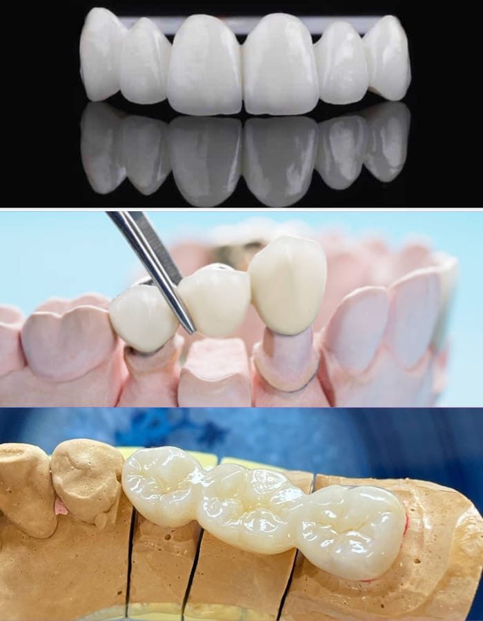 dental bridges illustration