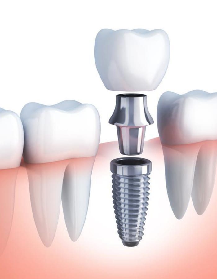 dental implants tooth replacement